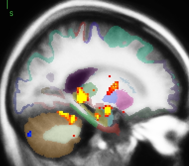 mni.group.encode.sag149.jpg