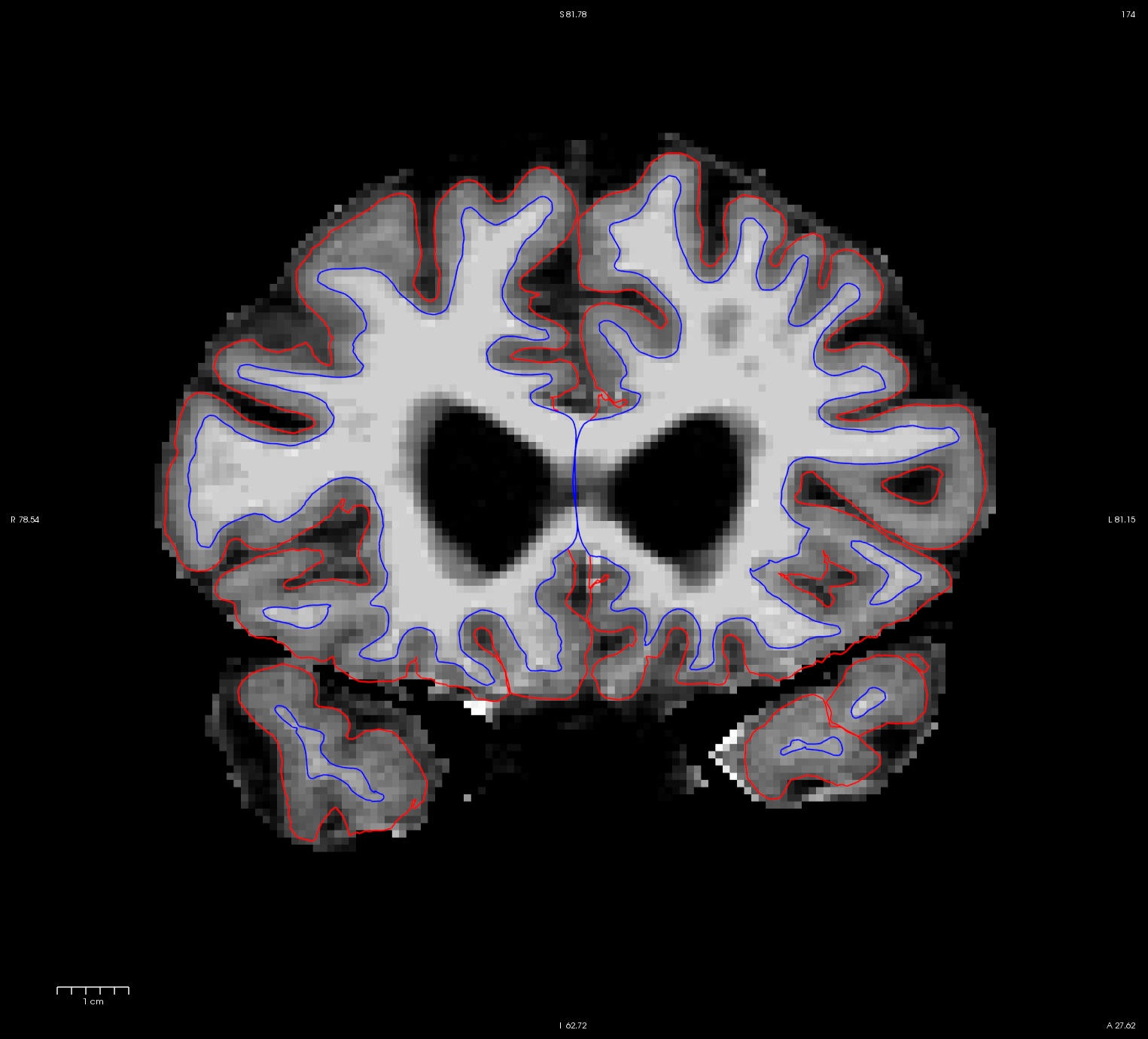 ps_slice_174_base_after.jpg