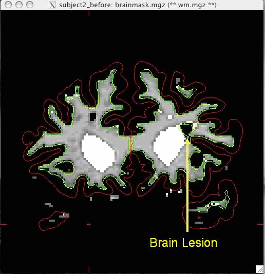 008_before_brainlesionWM2.jpg