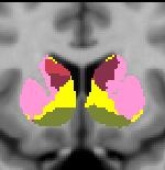 cluster017_loosemask_coronal.12.striatum.MNI152ReconAll1mm.png